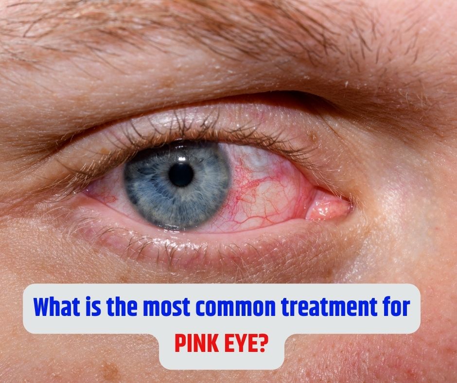 What Is The Most Common Treatment For Pink Eye Iris Eye Care