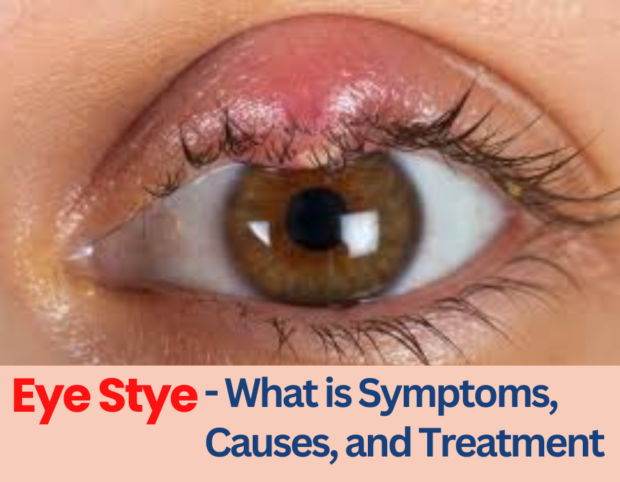 Eye Stye What Is Symptoms Causes And Treatment