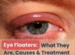 eye floaters-what they are, causes and treatment-Dr.Vasundhara Kulkarni-eye specialist in Pune