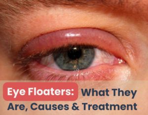 eye floaters-what they are, causes and treatment-Dr.Vasundhara Kulkarni-eye specialist in Pune