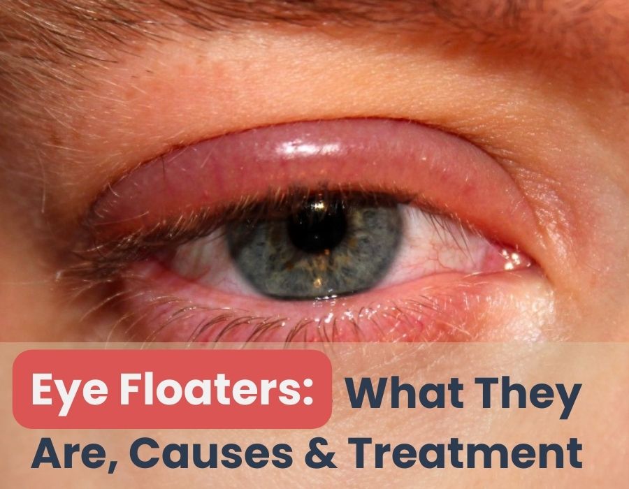 Eye Floaters What They Are Causes And Treatment Iris Eye Care