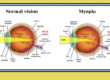 Myopia