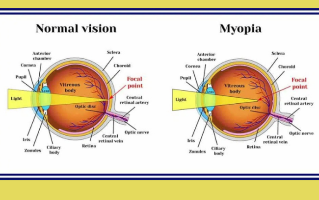 myopia Myopia