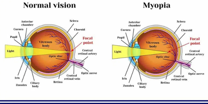 myopia Myopia