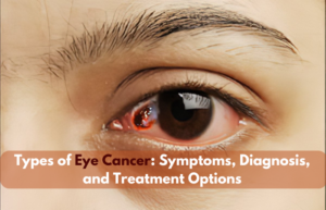 Types of Eye Cancer: Symptoms, Diagnosis, and Treatment Options 