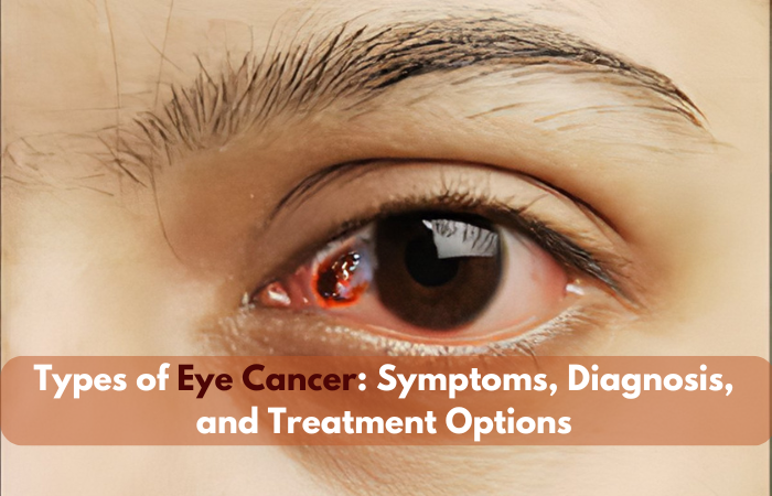 Types of Eye Cancer: Symptoms, Diagnosis, and Treatment Options