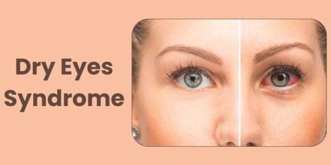 Dry Eyes Syndrome: Causes, Symptoms, and Effective Treatments