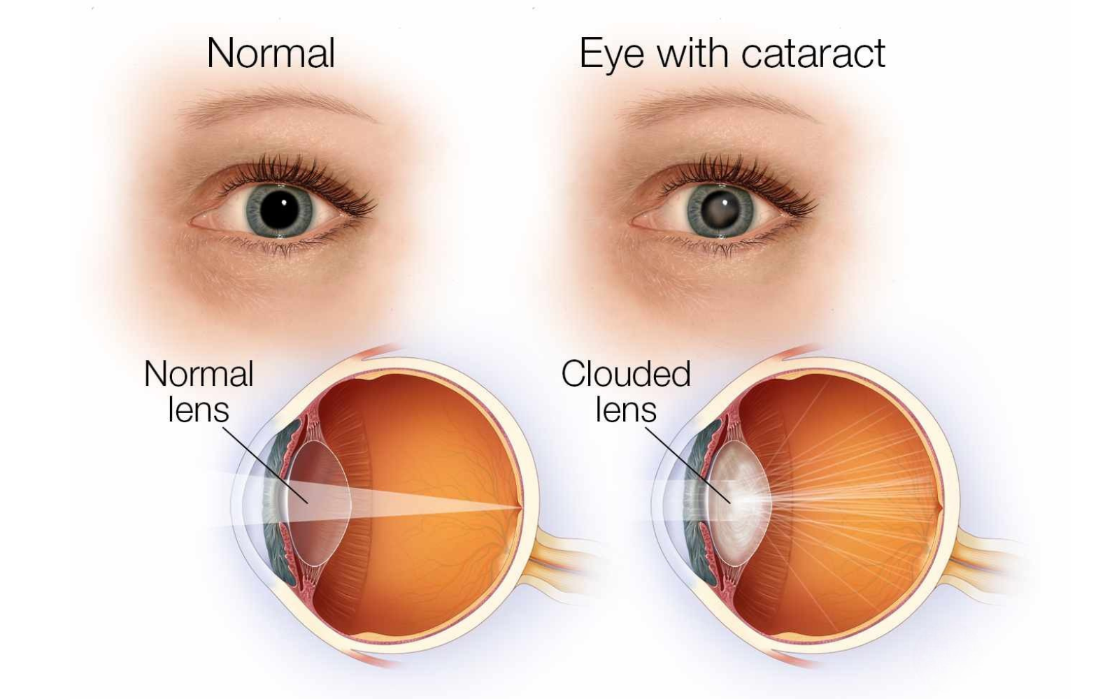 Cataract Treatment