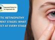 Diabetic Retinopathy Treatment Stages: What to Expect at Every Stage